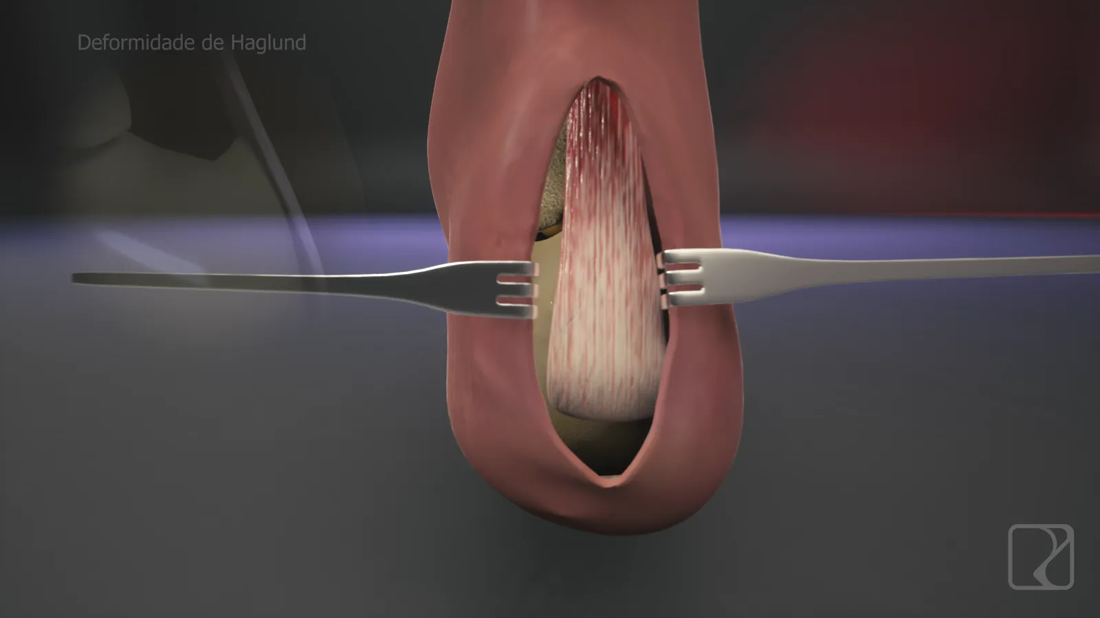 Calcanhar em 3D com afastadores, deformidade de Haglund