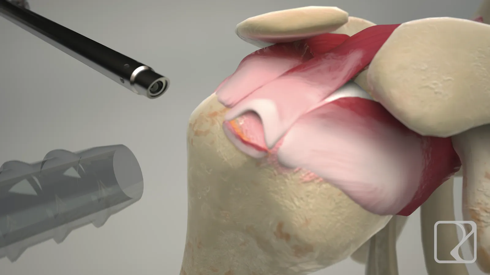 Ombro em 3D com cânula e instrumento