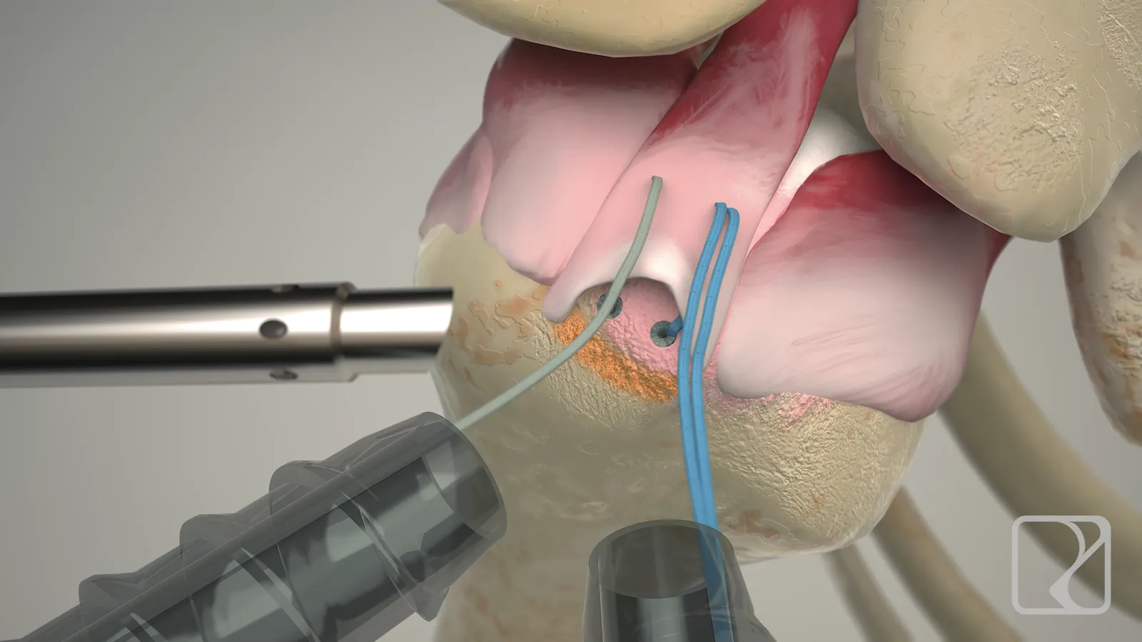 Animação 3D de cirurgia de ombro com instrumentos Razek
